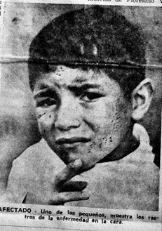 Un niño posa ante la cámara mostrando la afección cutánea por
exposición a químicos